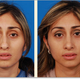 Illustration for article titled Nose Reshaping/Rhinoplasty em/em
